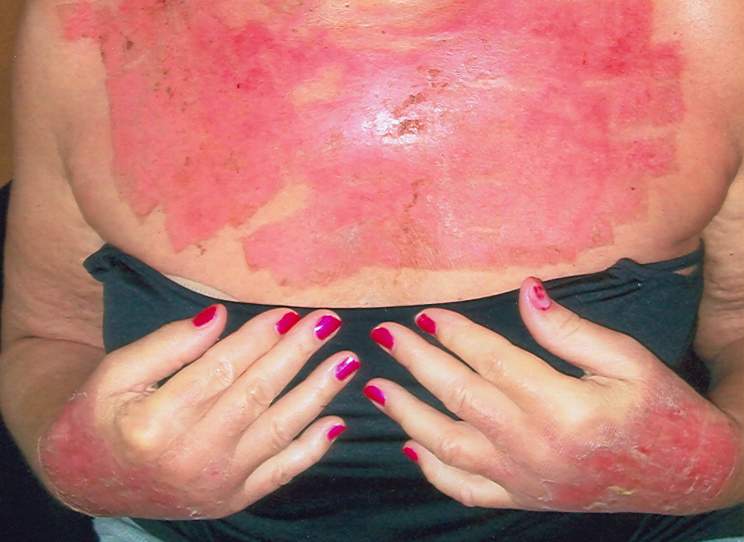 Woman warns of cosmetic laser treatment - image