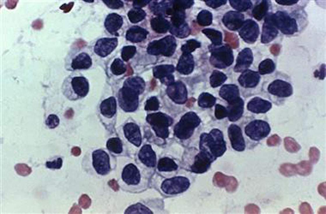chemotherapy drugs Ontario low dosing