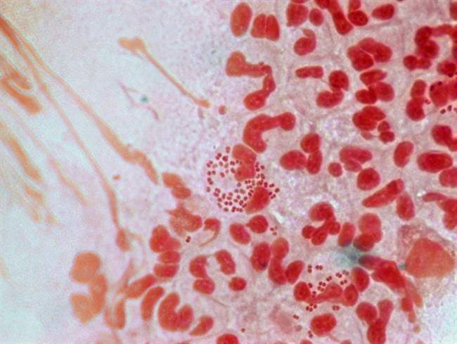 Gonorrhea, a STI