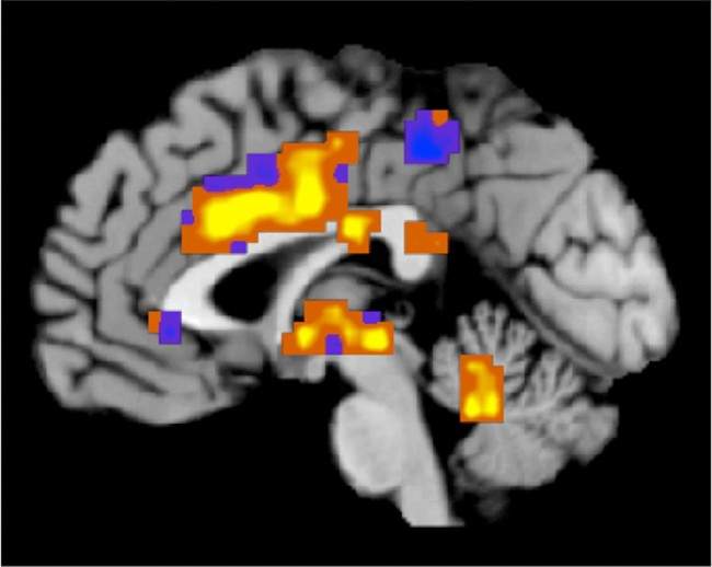 From healing brain injury in children with a diabetes drug to diagnosing Alzheimer’s with an eye exam, five major research projects announced yesterday by Brain Canada are focused on “translational” medicine, aimed less at the pure mysteries of the mind and more at helping patients recover from specific diseases.
