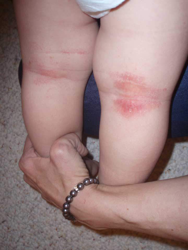 Two year old Bodhi’s legs in March 2013. His mother, Thera Breau, believes that the rash was caused by fumes emanating from Baytex’s nearby bitumen tanks. Photo courtesy of Thera Breau.