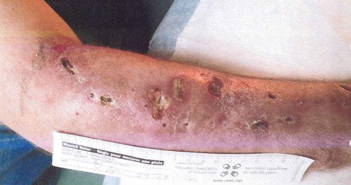 Antidepressant Wellbutrin becomes ‘poor man’s cocaine’ on Toronto streets - image