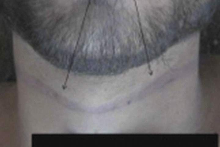 A transverse ligature mark across the anterior surface of the neck of man allegedly killed while in Syrian detention.