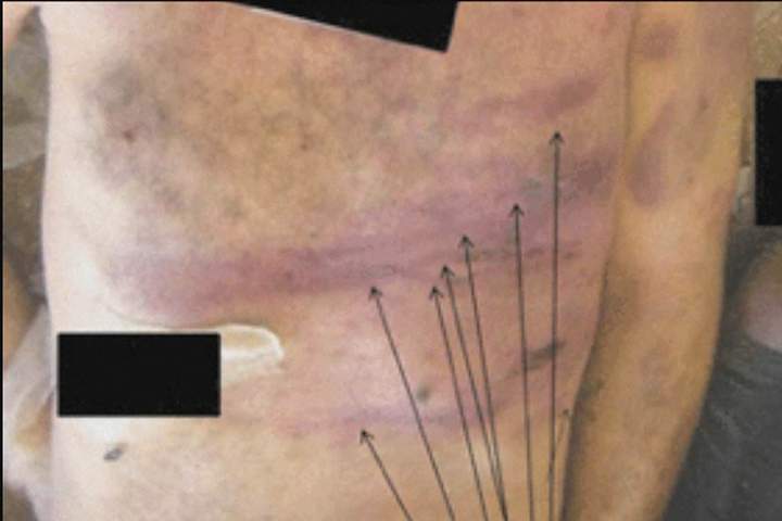 “Tramline” injuries across the anterior chest and abdominal wall of an individual who was allegedly killed while detained by Syrian authorities.