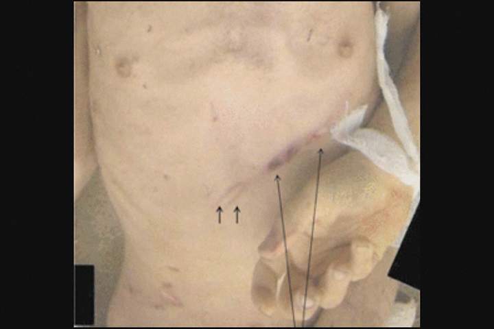 Image of an emaciated individual with “tramline” injuries across the lower chest.