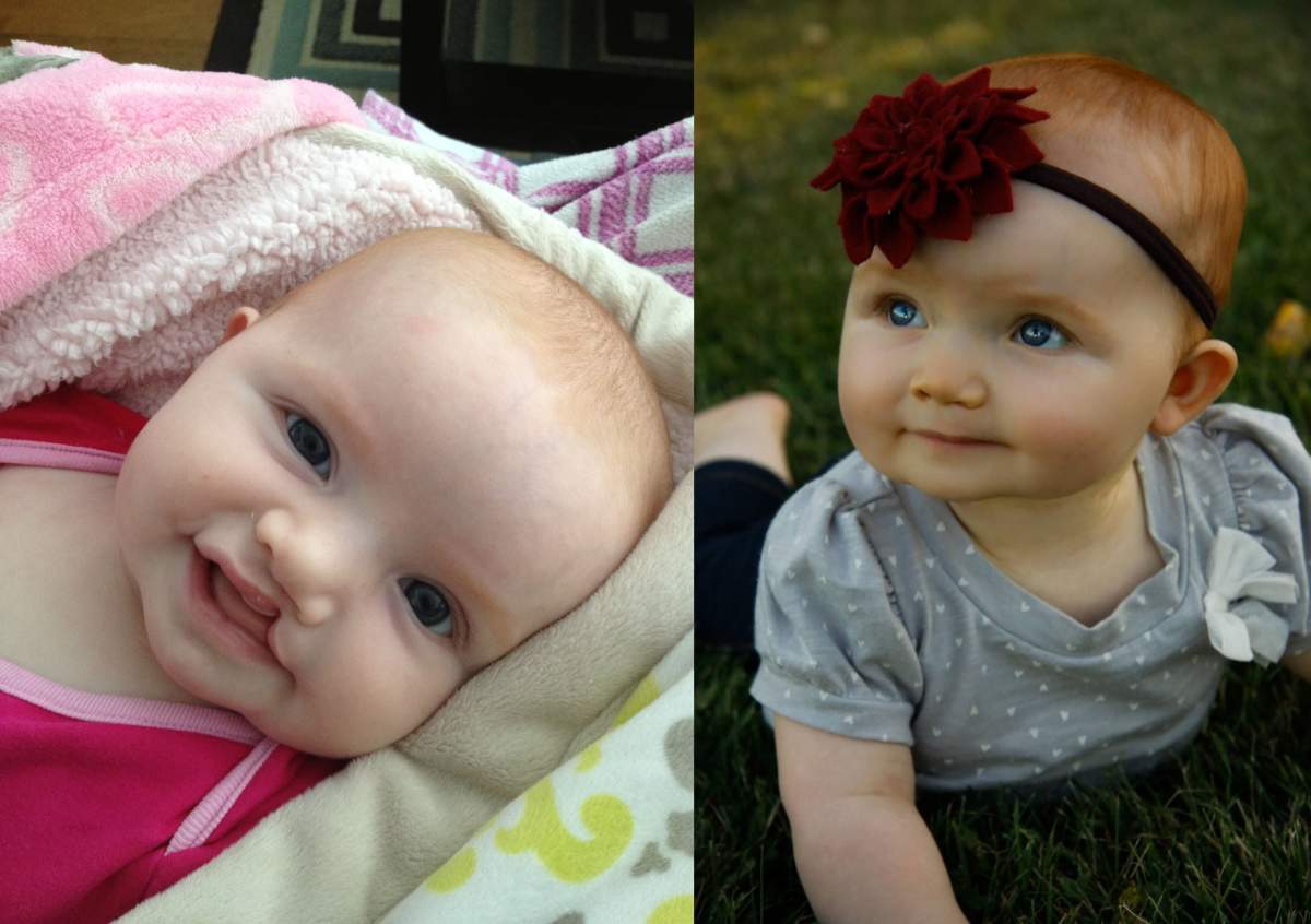 cleft lip, before and after