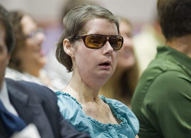 FILE - In this Aug. 10, 2012 file photo, Charla Nash sits before a hearing at the Legislative Office Building in Hartford, Conn., to determine whether she may sue the state for $150 million in claimed damages.