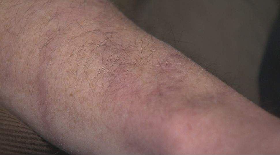 One man’s painful temporary tattoo experience has him warning others - image