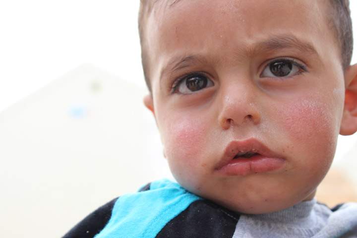 A baby with a rash in Azraq Camp