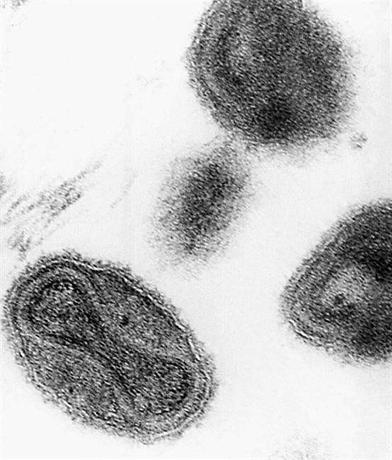 Smallpox