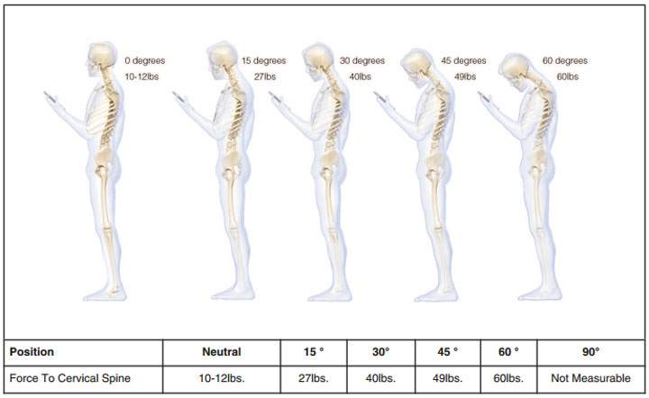 Sit up straight: Why your smartphone is wreaking havoc on your back - image