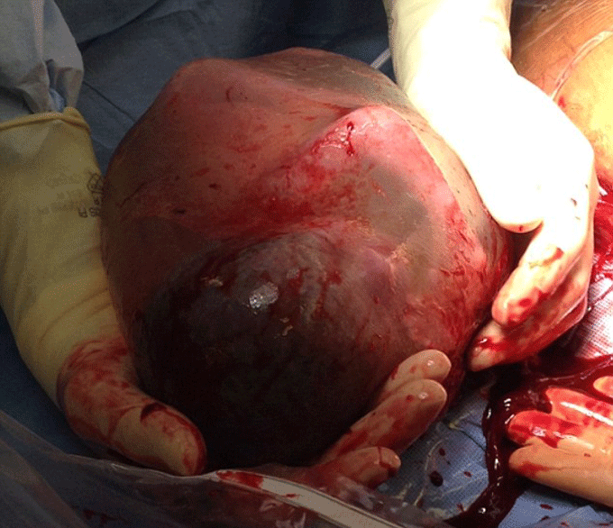 Going viral: ‘Miracle baby’ born encased in amniotic sac - image