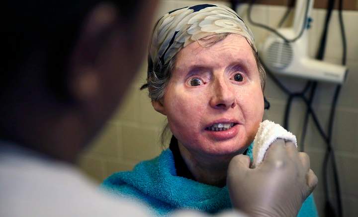 In this Friday, Feb. 20, 2015 photograph, Charla Nash smiles as her care worker washes her face at her apartment in Boston.  The Department of Defense is following Nash's progress, after funding her transplant surgery in 2011. Nash lost her face, eyes and hands after being mauled by a chimpanzee in 2009.