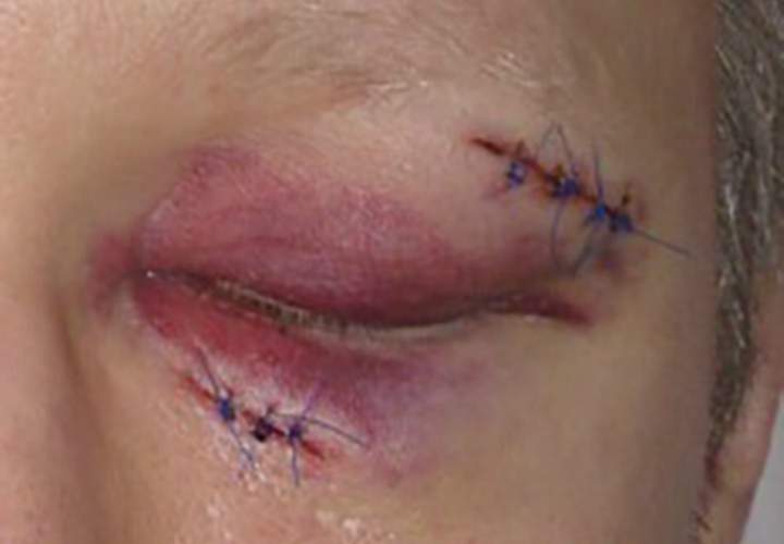 A nurse was attacked at Abbotsford Regional Hospital over the weekend, says the BC Nurses’ Union.