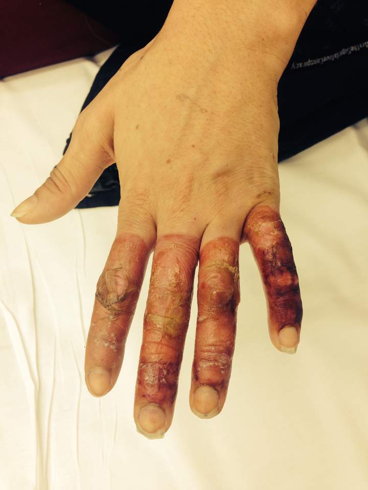 The good news is that her hands are healing and that it looks like she will be able to keep her fingers.