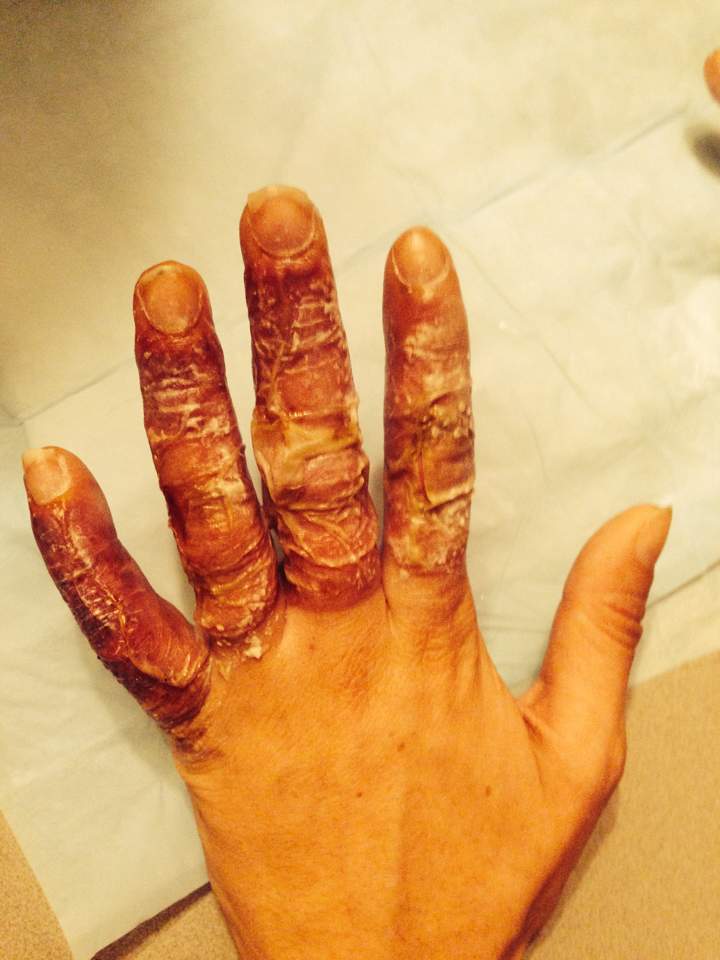 This shows her fingers after the doctor cut open the blisters.“Puss went everywhere. EVERYWHERE.”