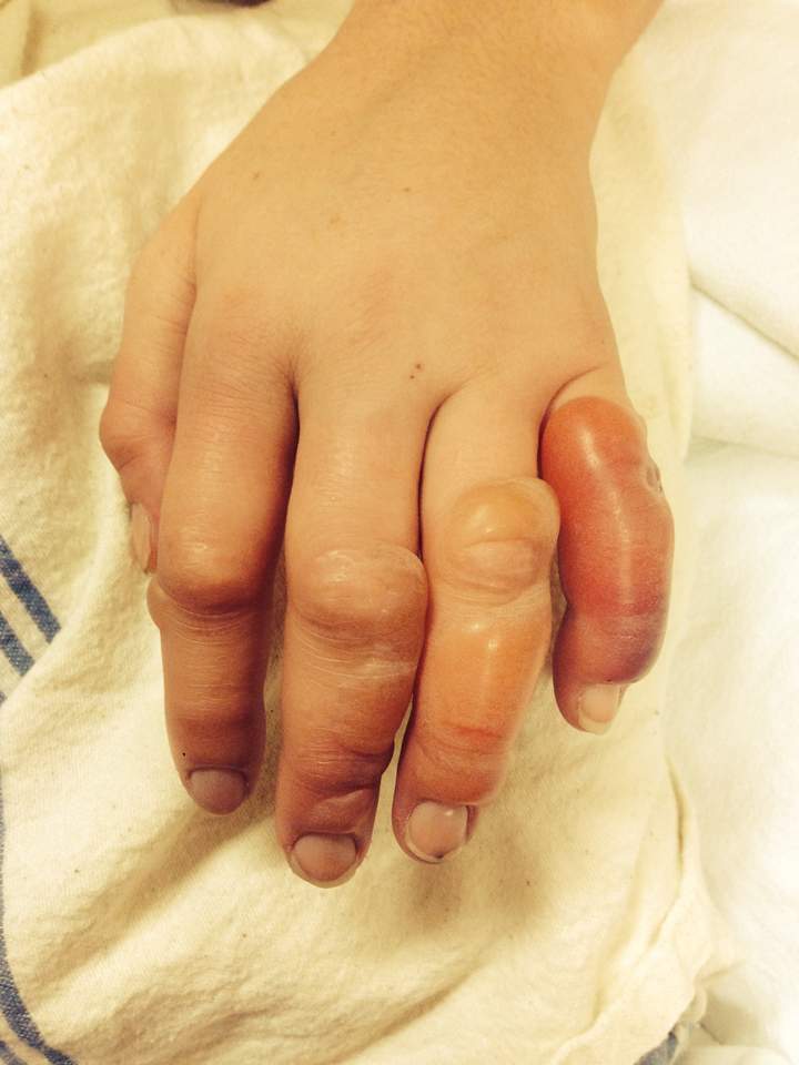 “Everyone wanted to check out my sweet blisters and find out how long an Aussie can withstand the cold before almost dying. Apparently 3 hours is pretty piss-weak.”