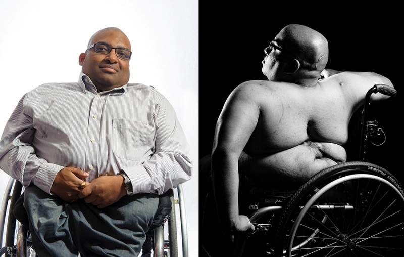 Photography exhibit shows spina bifida in new light - image