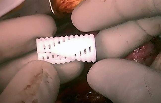 3 boys saved by customized airway tube made on 3-D printer - image