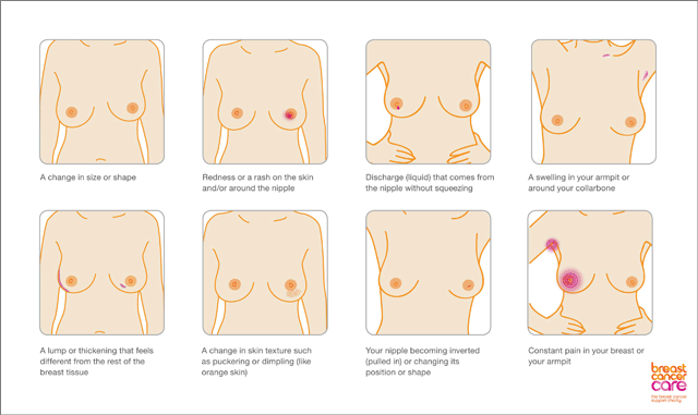 A lump in the breast is a tell-tale sign that women should visit their doctors to check for breast cancer, but what about other lesser known signs?