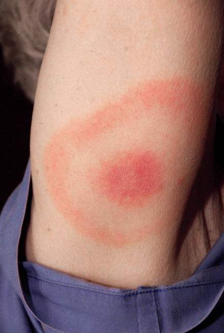 A rash in the pattern of a bulls-eye, which formed after a tick bite on this Maryland woman’s right upper arm, who subsequently contracted Lyme disease is shown in a photo released by the Centers for Disease Control and Prevention.