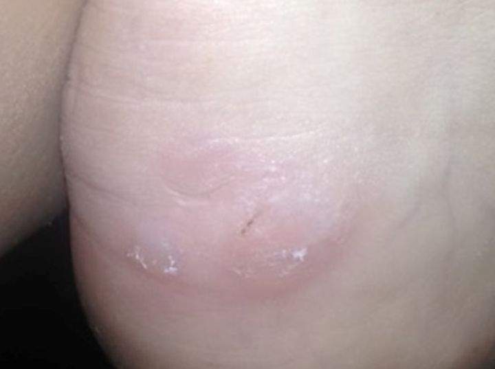 High heels pain