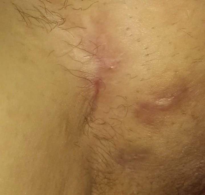 Mandy Tarala’s Hidradenitis Suppurativa after healing with medical marihuana.