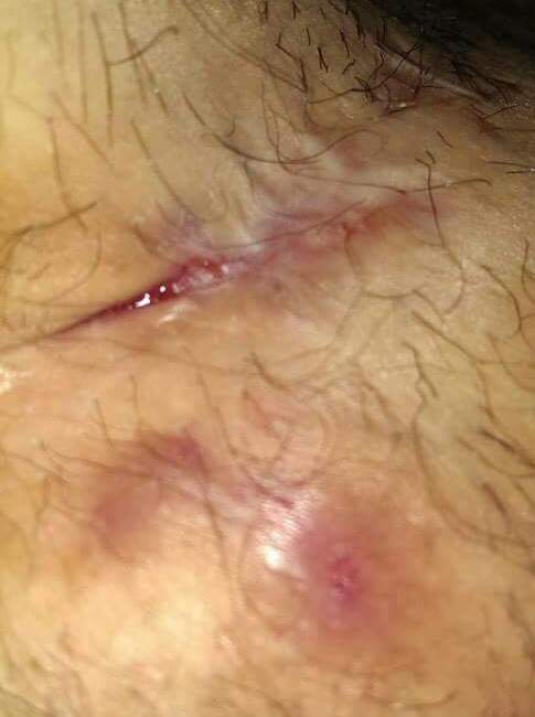 Mandy Tarala’s Hidradenitis Suppurativa during healing process.