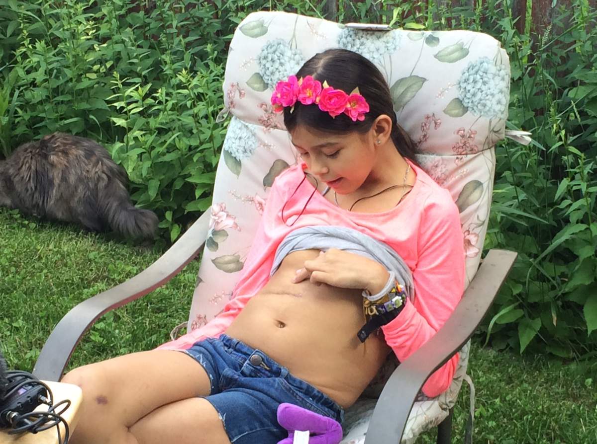 Allexis shows off her scar to media Wednesday after successful liver surgery