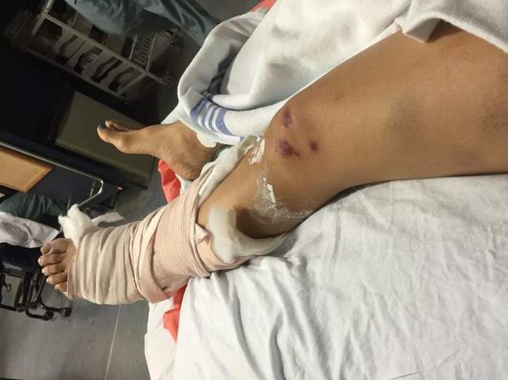 Mailane Bituin posted this photos on Facebook to document her recovery, Friday, July 24, 2015.