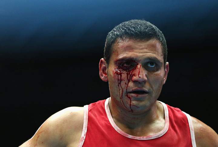 Samir El-mais of Canada is seen with a bloodied eye during his bout againsts Warren Baister of England during the Men's Heavy 91kg quarterfinal at Scottish Exhibition And Conference Centre during day seven of the Glasgow 2014 Commonwealth Games on July 30, 2014 in Glasgow, United Kingdom.