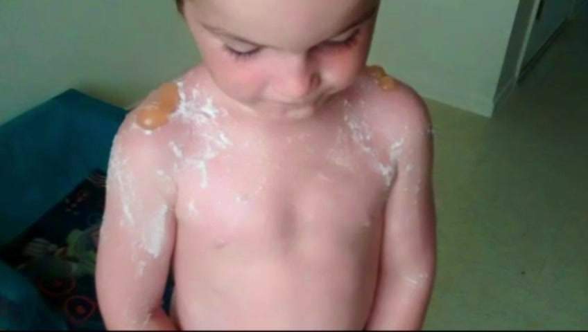 Mother blames daycare after young boys suffer horrific sunburns - image