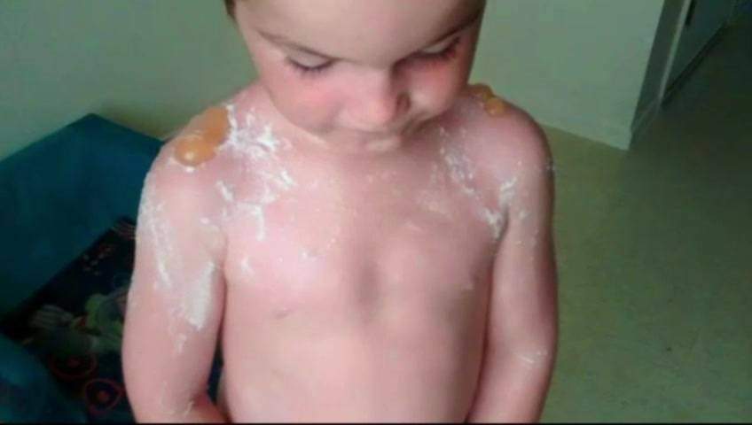 Boys who suffered horrific sunburns were in the sun less than 2 hours - image