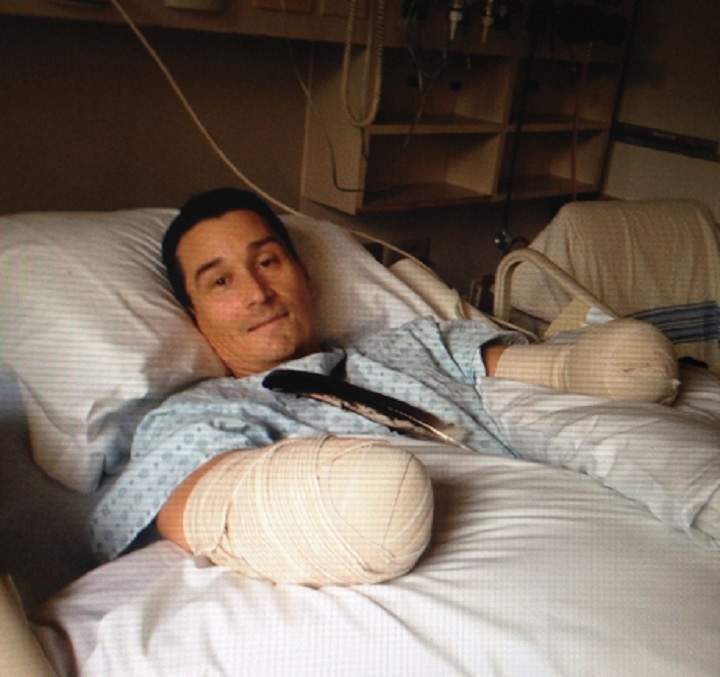 Taras Atleo after an industrial accident forced the amputation of both his hands.