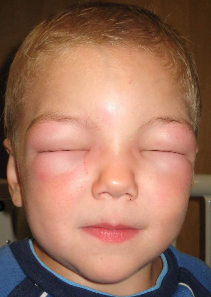 Potentially fatal allergic reactions prompts response from ER doctors - image