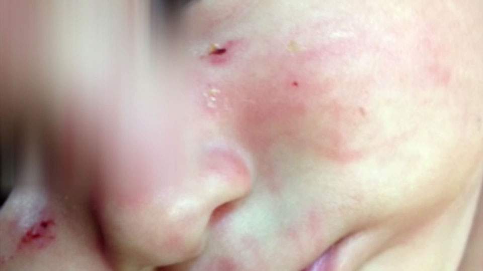 Texas infant bitten 27 times by another child, unlicensed home daycare closed - image