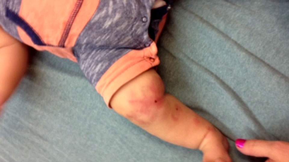 Texas infant bitten 27 times by another child, unlicensed home daycare closed - image