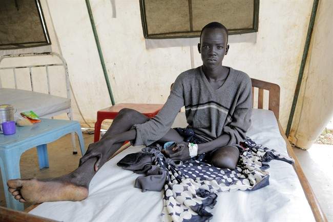 In this photo taken Saturday, July 8, 2015, Banywich Bone, 18, who had his left leg amputated after a severe infection which developed following a snake bite, convalesces at Agok hospital, South Sudan.