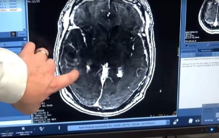 Scientists pursuing the biological roots of schizophrenia have zeroed in on a potential factor - a normal brain process that gets kicked into overdrive.