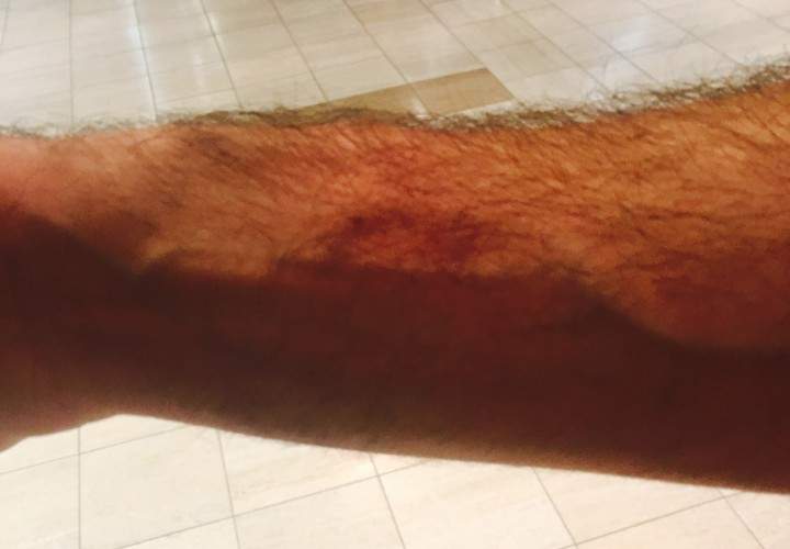 Steve Merling took photos of his bruises after allegedly being assaulted by an SAQ employee.