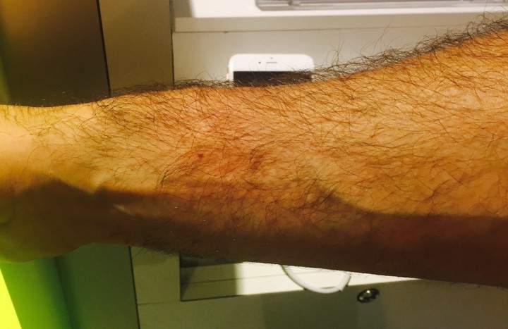 Steve Merling took photos of his bruises after allegedly being assaulted by an SAQ employee.