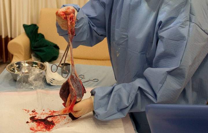 In a photo taken on February 20, 2012 a doctor holds a placenta in the delivery room of a hospital in Beijing. The health-giving qualities of placenta are currently creating a buzz in Western countries, where some believe it can help ward off postnatal depression, improve breast milk supply and boost energy levels. But placentophagy, the practice of eating one's placenta after birth, is relatively common in China, where it is thought to have anti-ageing properties, and dates back more than 2,000 years.