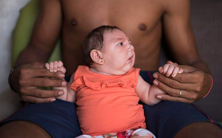 A child with microcephaly. The condition results in a smaller than normal head at birth, and can sometimes lead to developmental problems, learning disabilities, hearing loss, vision loss or epilepsy.
