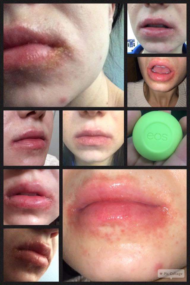 Popular celebrity-endorsed lip balm EOS subject of class-action lawsuit - image