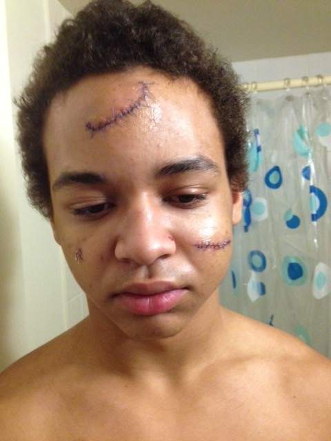 Jaiden Hyland shows his scars after he smashed through a wired glass window at his high school in 2013