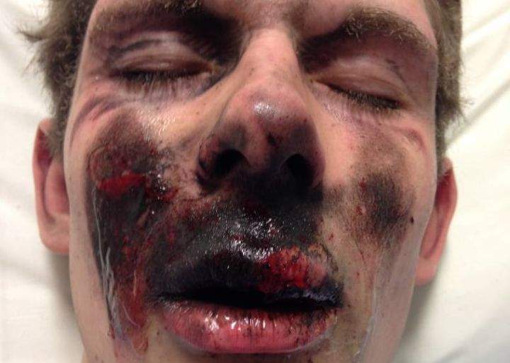Ty Greer says his e-cigarette exploded on him, causing severe burns.