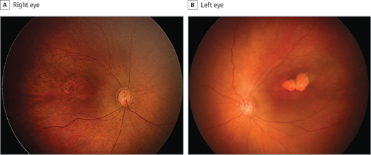 The photos above are of a two-month-old baby girl. The right eye has mottling of the retinal pigment (A), and the left eye has a lesion and slight pigmentary mottling (B).
