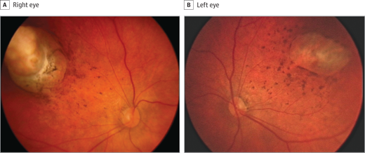 The photos above are of a one-month old baby boy, who had retina damage.  A study in JAMA Ophthalmology found eye abnormalities in infants infected with the Zika virus.