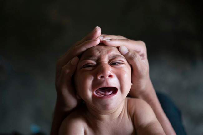 Zika virus causes microcephaly and other birth defects, U.S. officials confirm.