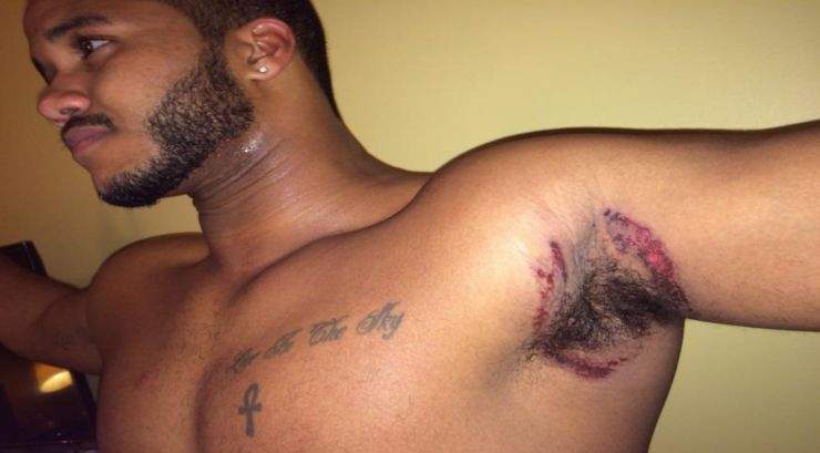 Plaintiff Rodney Colley shows the rash he claims he received from using Old Spice deodorant.
